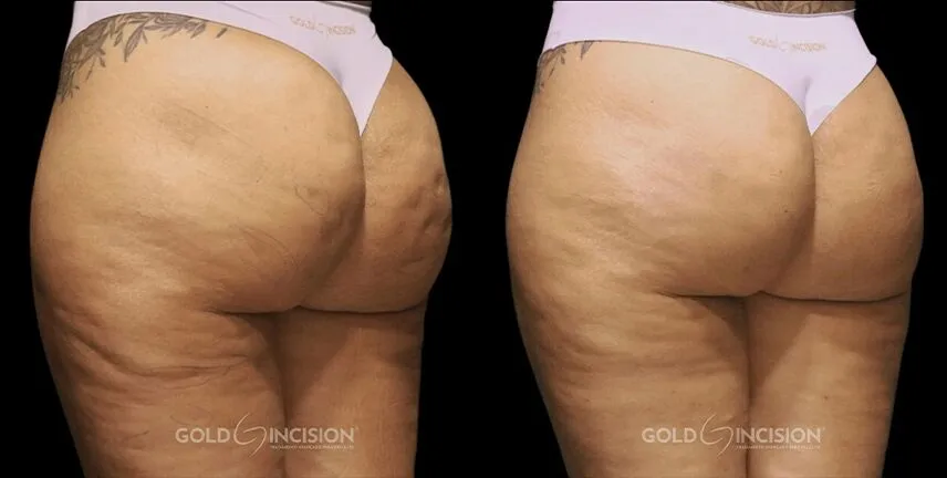 glutathione cellulite Cellulite Treatment in Bellevue, WA