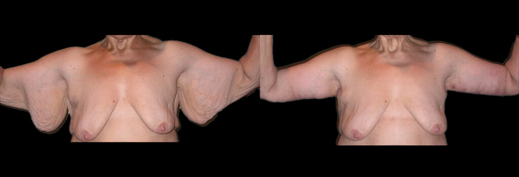 Arm Lift