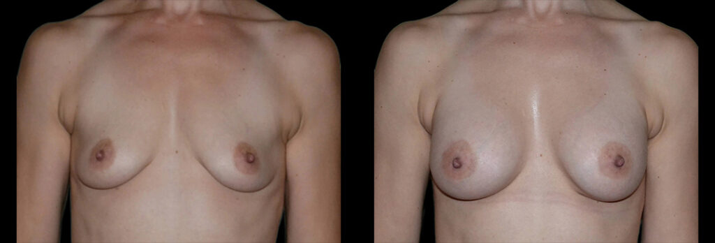 a woman's bare chest before and after breast enhancement in Bellevue, WA