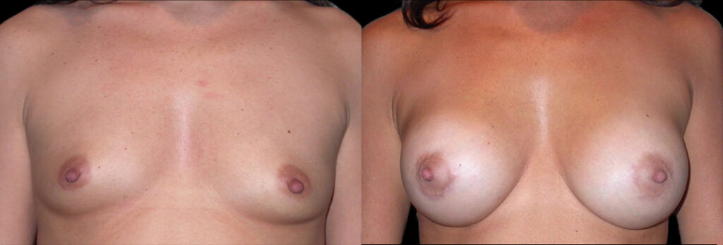 a woman's bare chest before and after breast enhancement in Bellevue