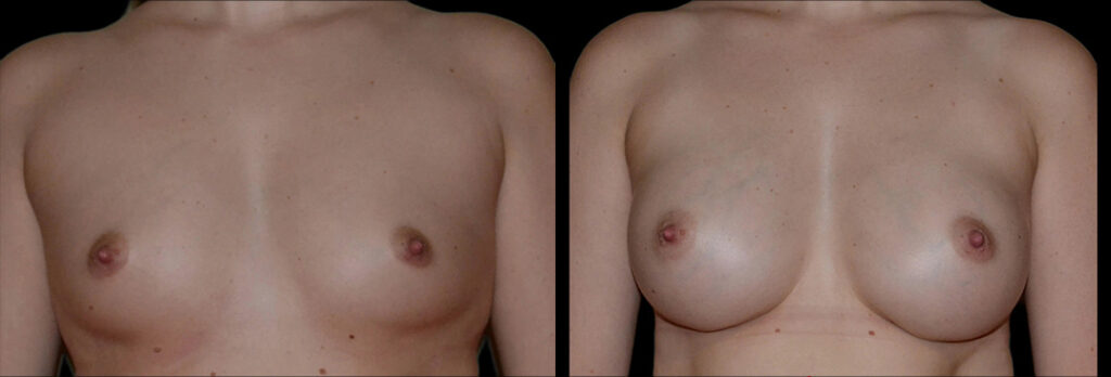 a woman's bare chest before and after breast enhancement in Bellevue, WA