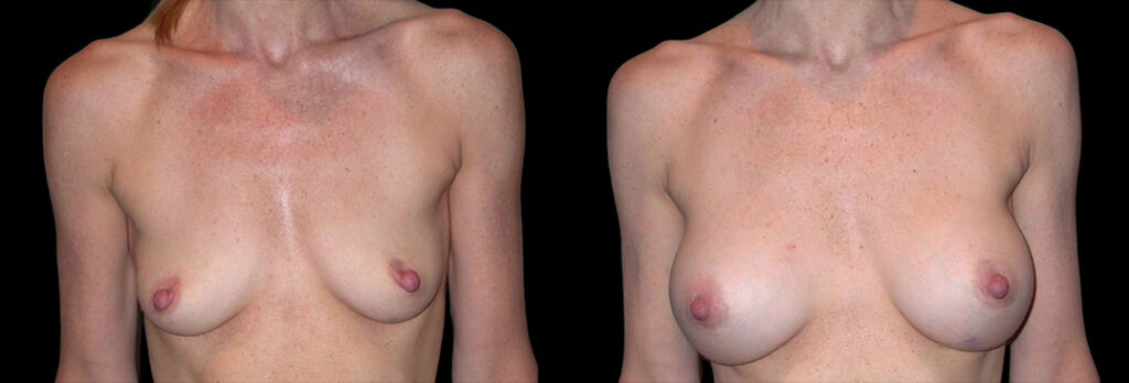 a woman's bare chest before and after breast enhancement in Bellevue, WA