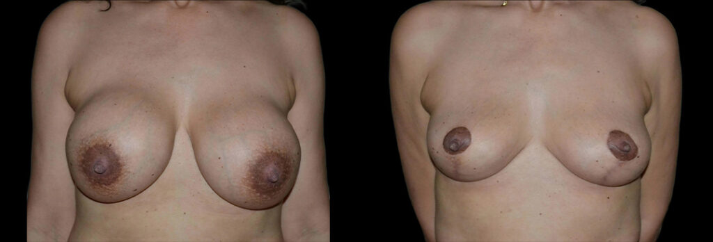 a woman's bare chest before and after breast lift in Bellevue, WA