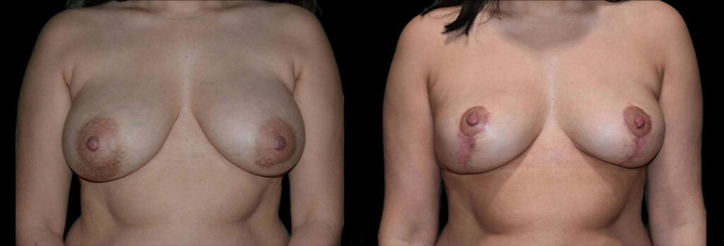 a woman's bare chest before and after breast lift in Bellevue, WA