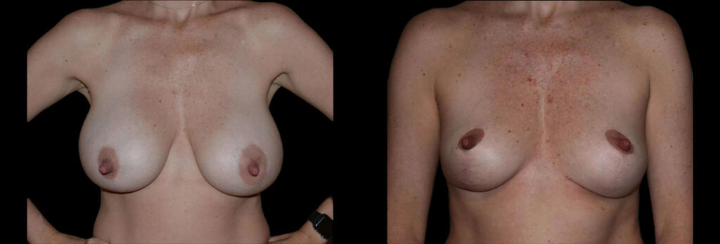 a woman's bare chest before and after breast lift in Bellevue, WA