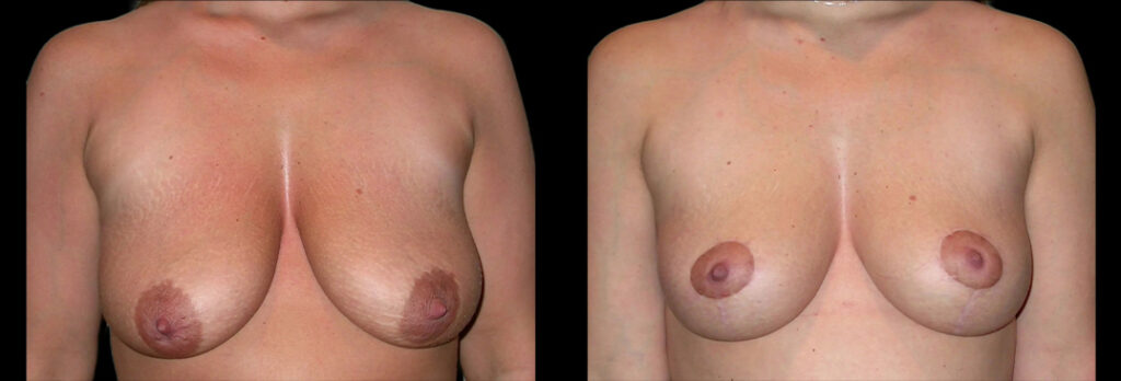 a woman's bare chest before and after a breast lift in Bellevue, WA