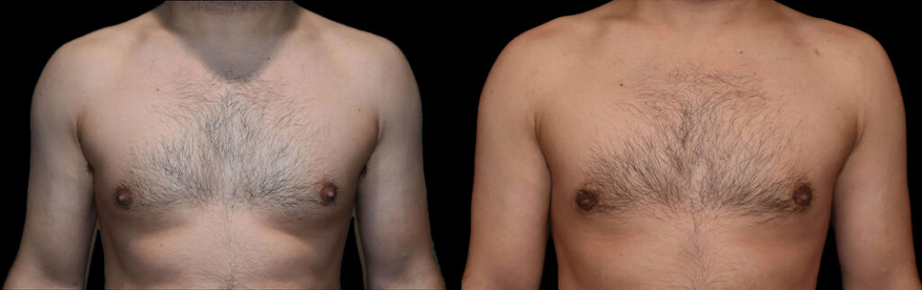 a man's bare chest before and after gynecomastia in Bellevue