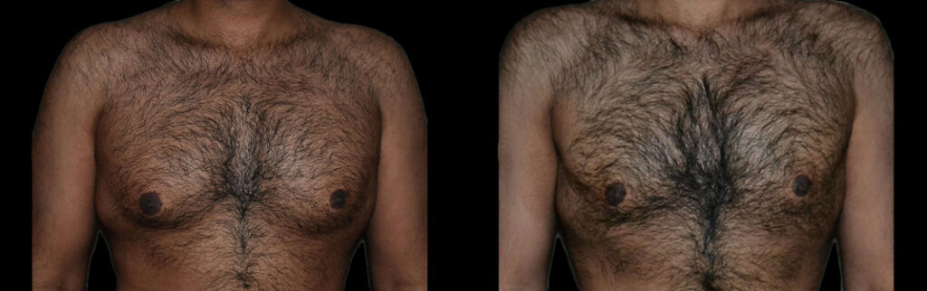 a man's bare chest before and after gynecomastia in Bellevue