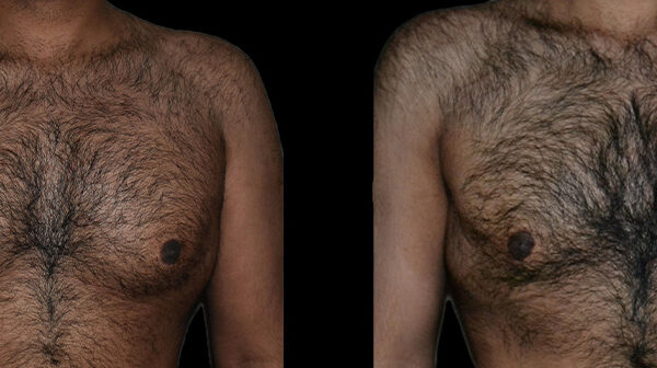 a man's bare chest before and after gynecomastia in Bellevue
