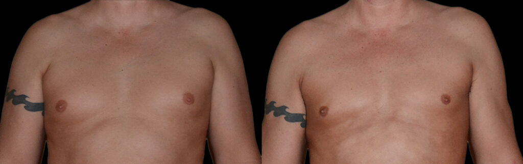 a man's bare chest before and after gynecomastia in Bellevue