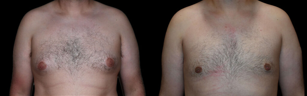a man's bare chest before and after gynecomastia in Bellevue
