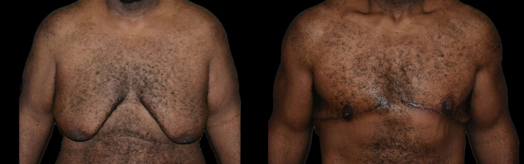 a man's bare chest before and after gynecomastia in Bellevue