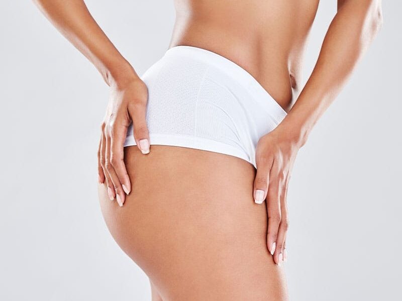 woman after her brazilian butt lift in Bellevue